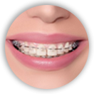 braces