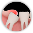 wisdom-tooth